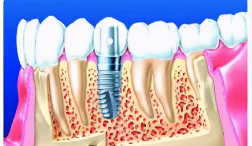 上海雅悦齿科种植牙,雅悦齿科种植牙