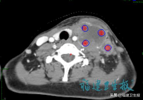 34岁女子宫颈癌自愈,女性患了宫颈癌能治愈吗