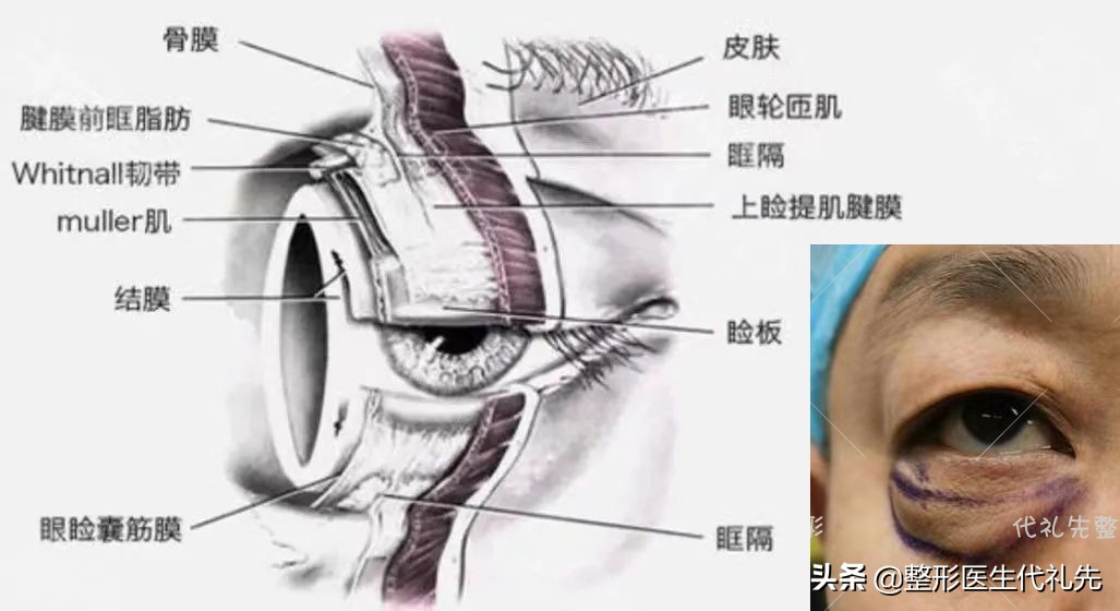 问一下有什么方法快速消除眼袋,关于眼袋的去除方法