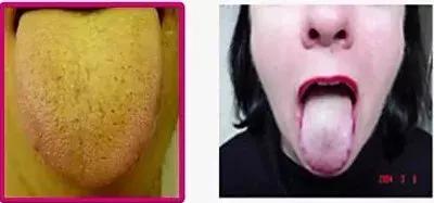 春夏两季湿气重该吃点什么,换季湿气太重了怎么排湿