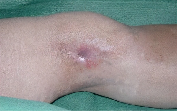 骨髓炎的原因及治疗办法,骨髓炎需要怎么治