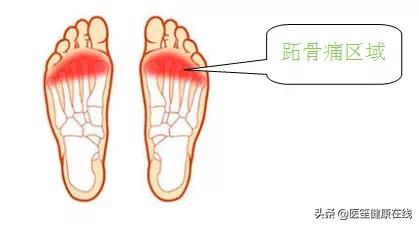 前脚掌老茧很疼,前脚掌起老茧怎么处理