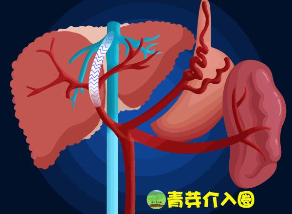 乙肝病人出现吐血便血大概活多久,乙肝吐血止血治疗方法