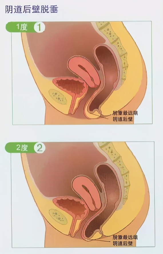 产后子宫轻度脱垂的人多吗,产后子宫脱垂和阴道壁膨出症状