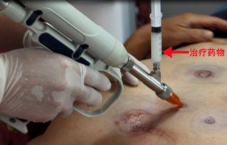 烧伤疤痕后遗症怎么治,烧伤愈合后疤痕处理案例