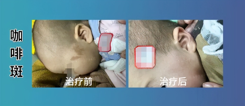 咖啡斑饮食注意事项,婴儿有咖啡斑注意事项