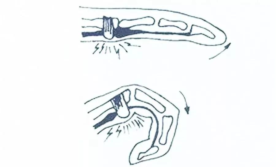 手指头伸不开一伸就疼,请问医生我手痛手指麻是什么原因