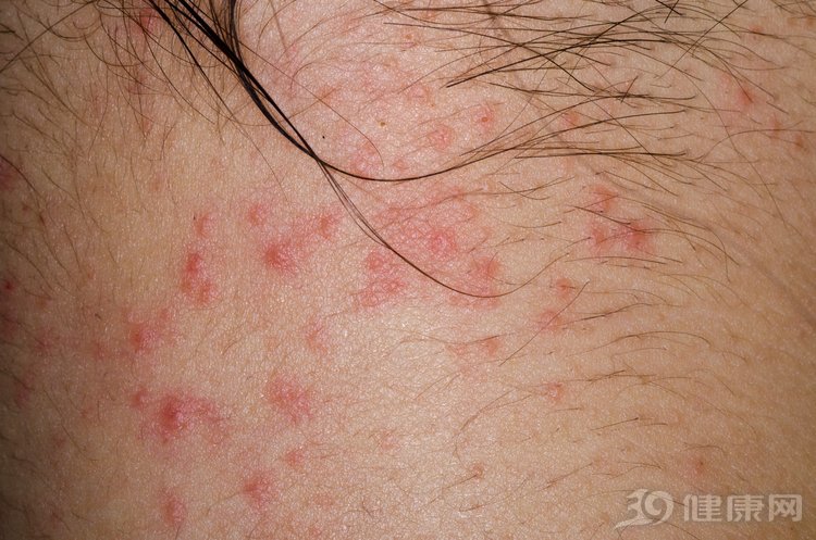 中医治疗湿疹效果最好的方法,中医怎么治疗湿疹最有效