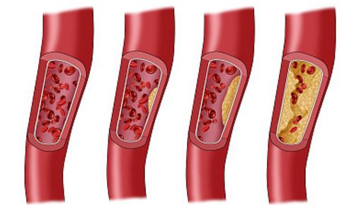 如何辨别真假心肌缺血,心肌缺血的亲身经历