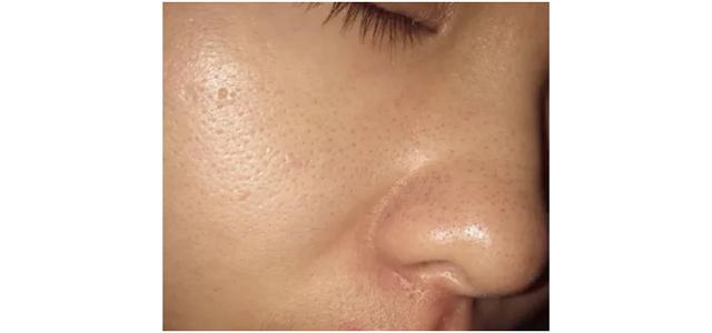 毛孔大皮肤粗糙怎么办,毛孔大皮肤变好