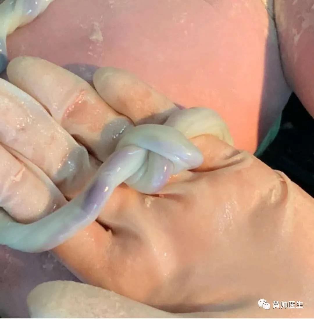 脐带疑似打结,脐带打结科普视频