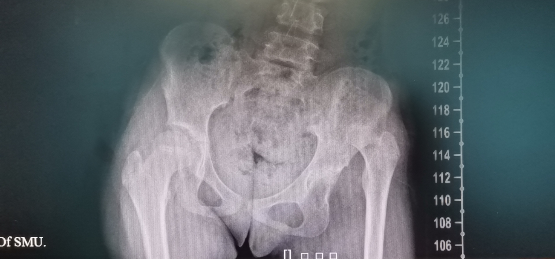 儿童发育性髋脱位表现,发育性髋关节脱位治疗4-7岁