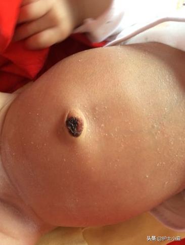 新生儿脐炎有脓怎么处理,新生儿脐炎肚脐渗水一般多久会好