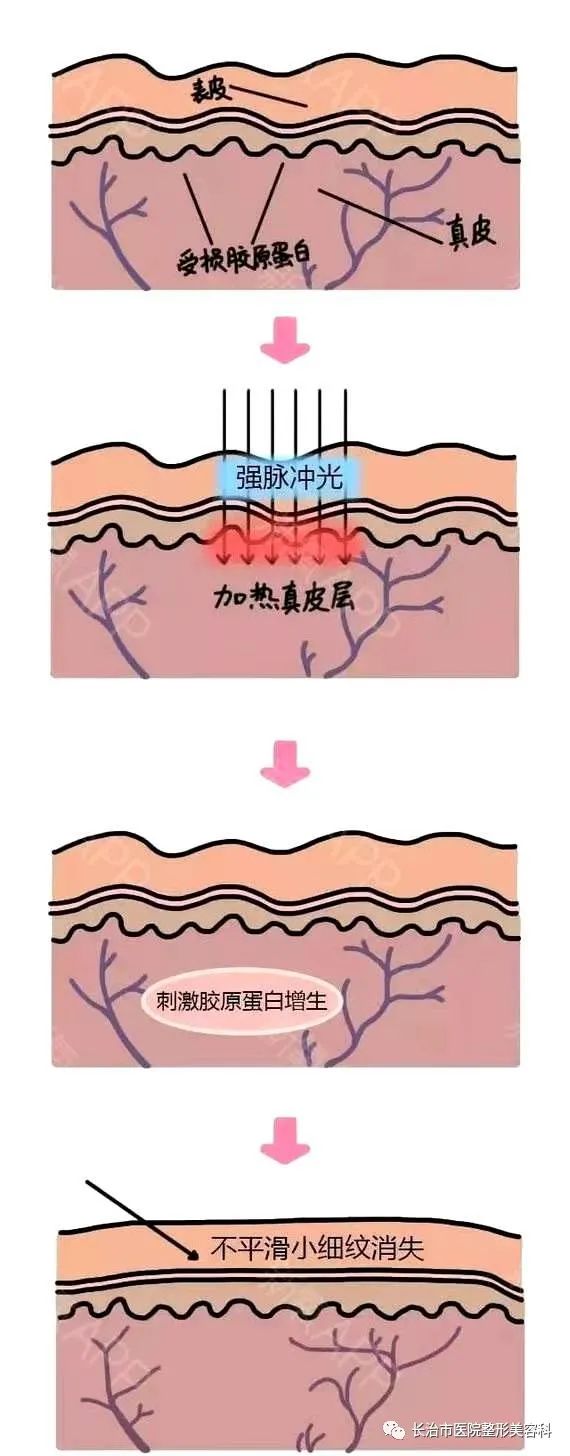 修复面部皮肤屏障的最好方法,怎样修复皮肤屏障加厚角质层
