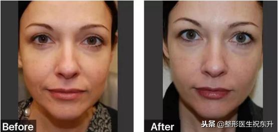 年龄大了想祛法令纹又不想动刀,泪沟法令纹不用动刀就能掩盖掉