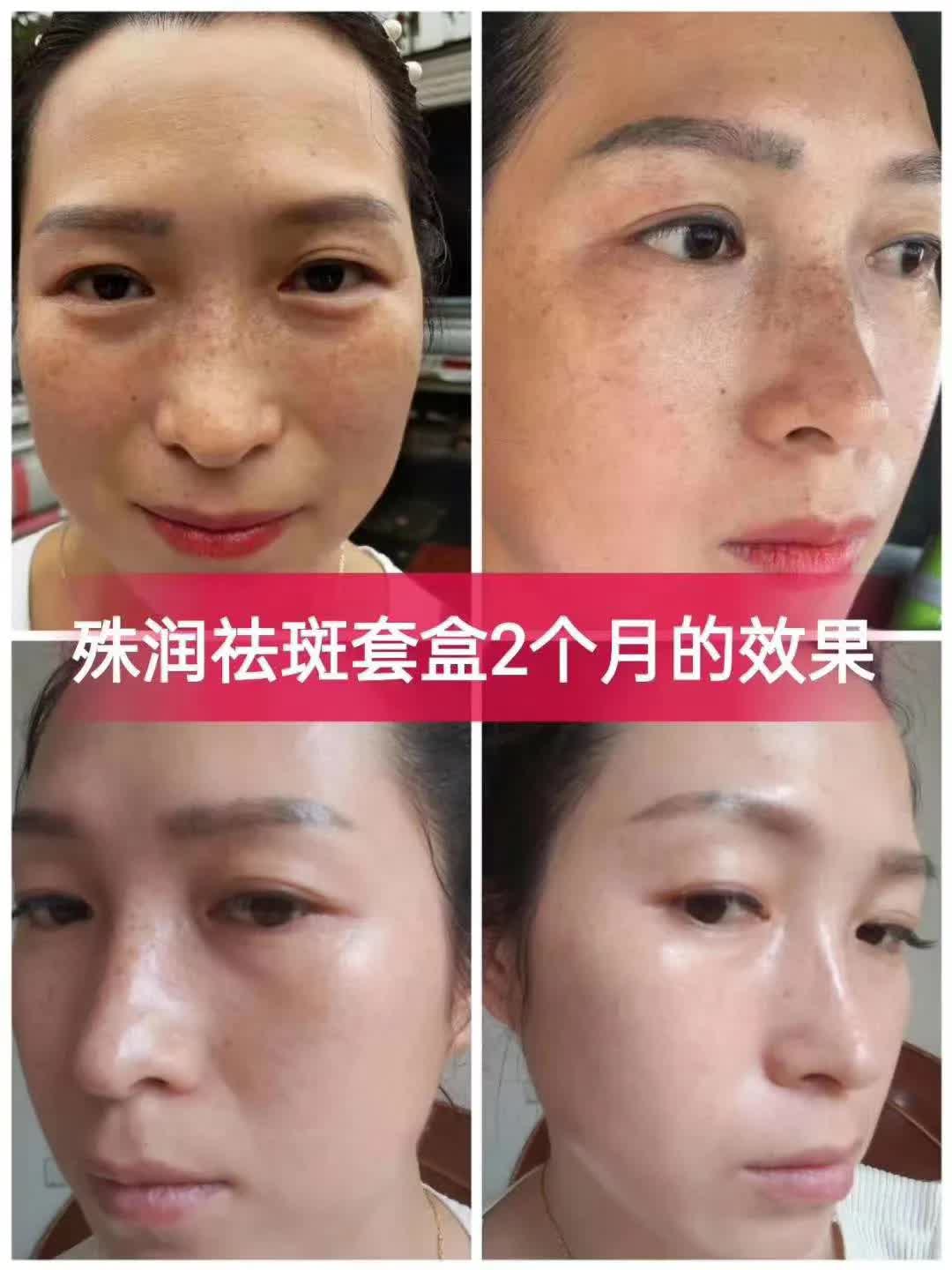 推荐好用的祛斑套盒,祛斑套盒推荐测评