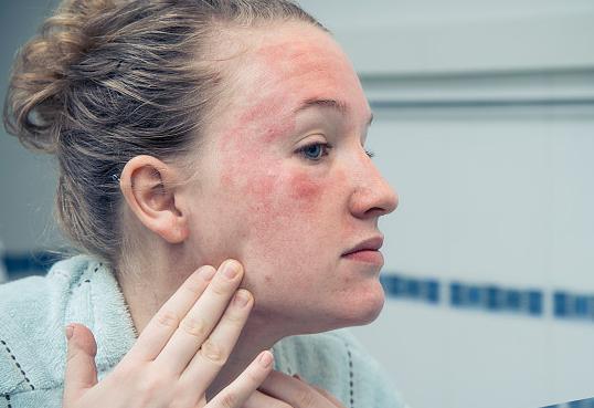 脸颊敏感红干怎么护肤,脸上敏感有红血丝怎么修复