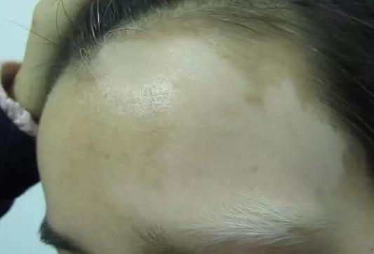 不看不知道，原来你患的是神经节段型白癜风