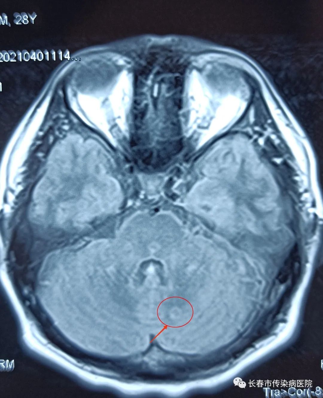 救命的3小时，惠民利民的“脑（膜）炎一站式快速诊断平台”望在全省逐步开展