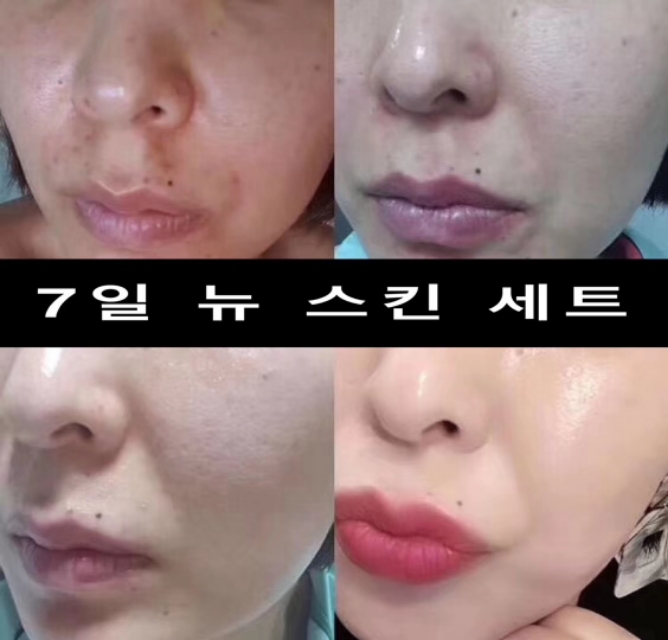 角质层增厚了皮肤好了,角质层健康