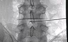榆林市中医院治腰椎间盘突出症,榆林市治腰椎椎间盘突出