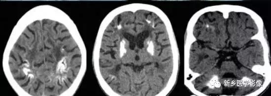 颅内有钙化怎么治疗,34岁脑部有钙化正常吗