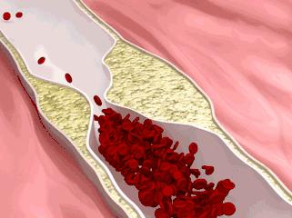 子宫肌瘤结节能治愈吗,肌瘤结节症状