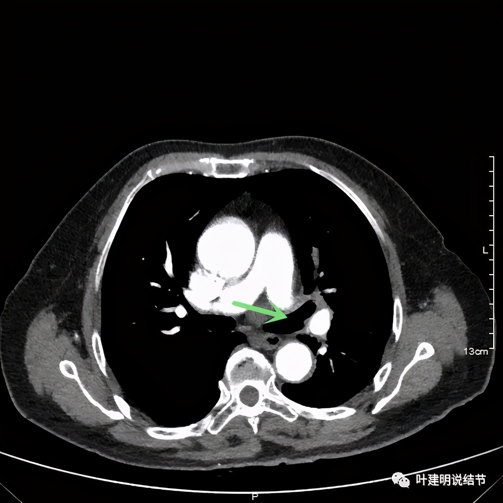 卡瑞利珠单抗治疗肺鳞癌有用吗,特瑞普利单抗对鳞癌治疗有效吗