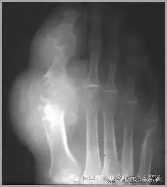 软组织钙化是不是骨化性肌炎,软组织钙化或骨化