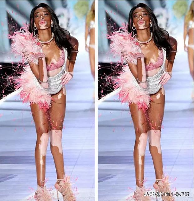 患白癜风的超模,有白癜风的国际名模