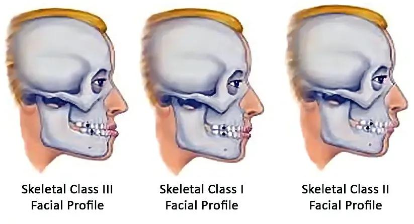 牙齿矫正真的可以提升颜值吗,牙齿矫正会让颜值提升