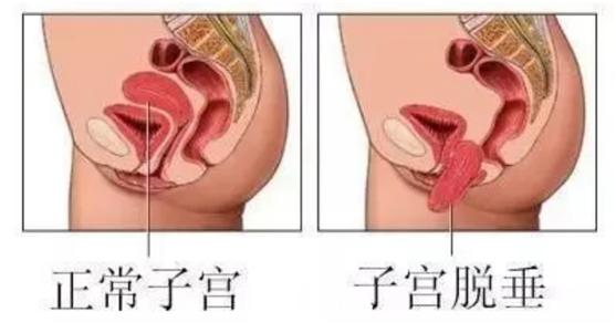 漂亮妈妈也有小尴尬–关爱女性,呵护盆底