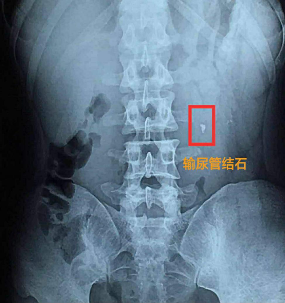 尿路结石有哪几种手术可以做,尿路结石手术是大手术么