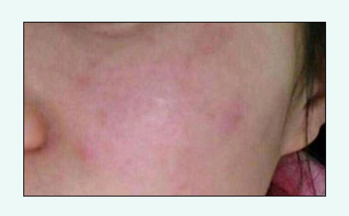 脸上的红疙瘩怎么彻底消除,脸上红疙瘩的种类