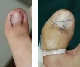 指甲老往肉里长化脓,指甲为什么一直往肉里长