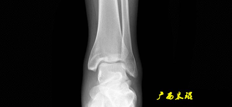 广西骨科医生米琨最新信息,米琨广西骨科什么水平