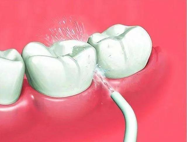 漱口水牙贴刷牙顺序,漱口水美白牙齿美加净