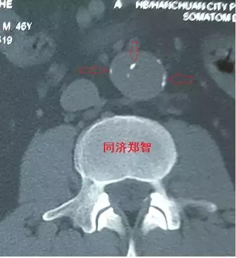 磁共振可以替代cta检查主动脉夹层,超声心动图联合cta诊断主动脉夹层