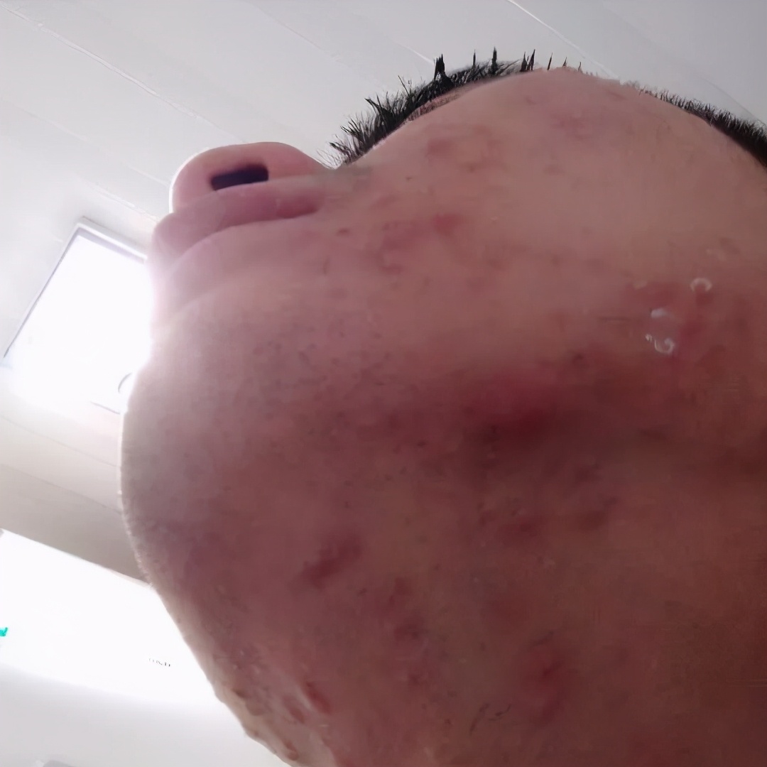 清理严重粉刺痘痘,严重的痘痘去除视频