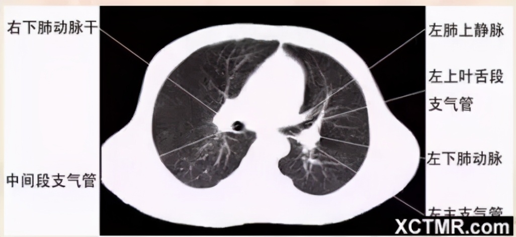 女性盆腔ct断层解剖结构图,女性盆腔脏器ct解剖