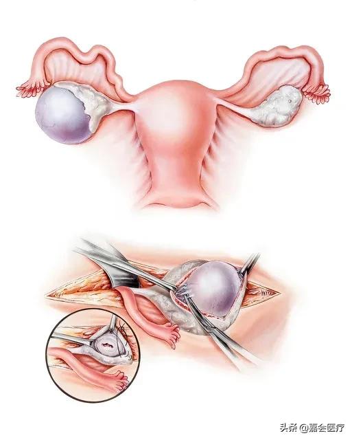 孕期卵巢囊肿越来越大还疼怎么办,孕期卵巢囊肿扭转是哪里疼