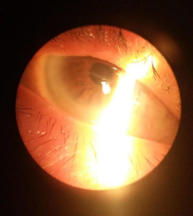 嘉兴中医院眼科结膜炎,新华医院眼科结膜炎