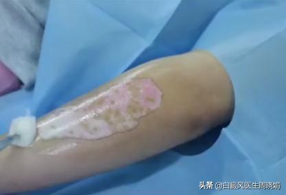 白斑植皮手术,白斑做手术