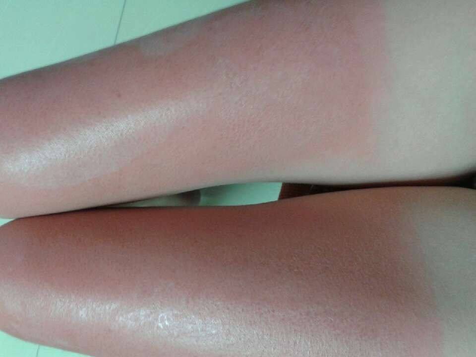 不小心晒伤怎么办?家居必备护理方法分享