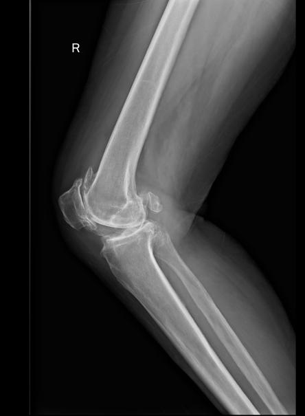 哪个医院治疗膝骨性关节炎最好,膝关节炎您想了解的小知识