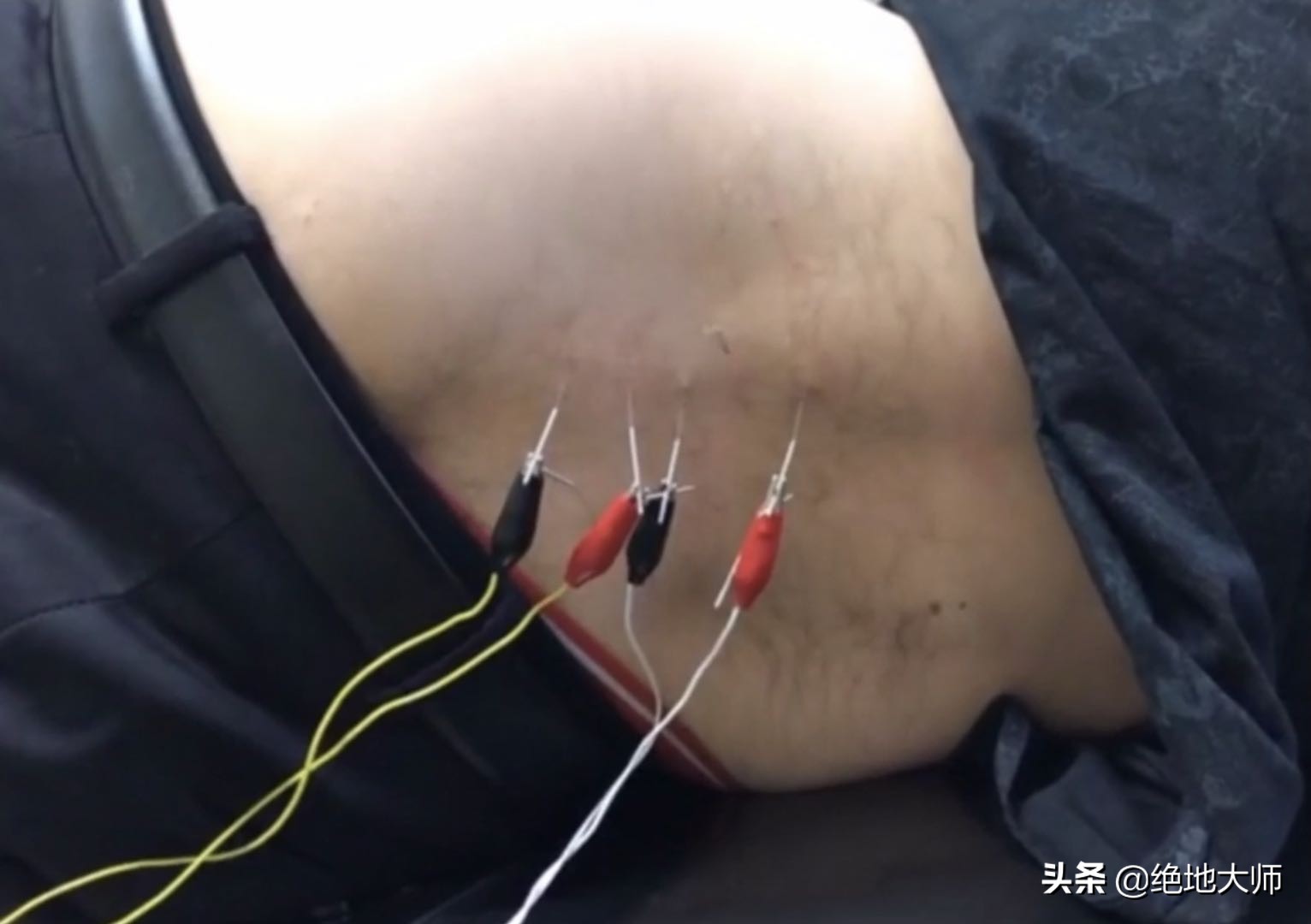 坐骨神经痛怎么治疗康复,坐骨神经疼吃哪种营养神经的药