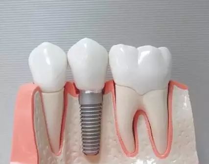 牙齿缺失后不镶牙有啥危害,牙齿缺失后不补有什么危害