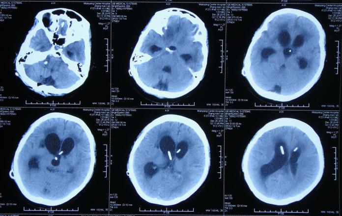 结核性脑积水,脑膜炎脑积水要治疗多久