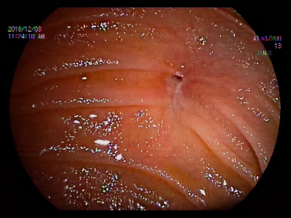 八年胆汁流通不畅，老奶奶成了“小黄人”……