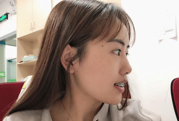 牙套隐形日记,牙套日记正颌